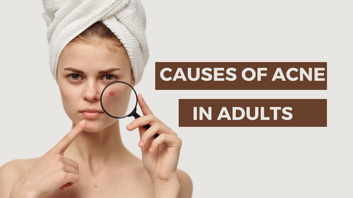 Unmasking the Culprits: Understanding the Causes of Acne in Adults
